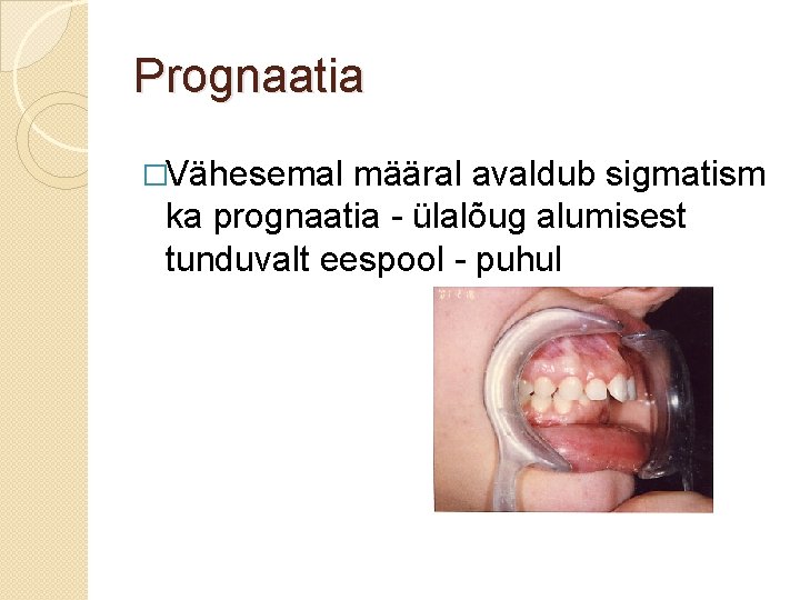 Prognaatia �Vähesemal määral avaldub sigmatism ka prognaatia - ülalõug alumisest tunduvalt eespool - puhul