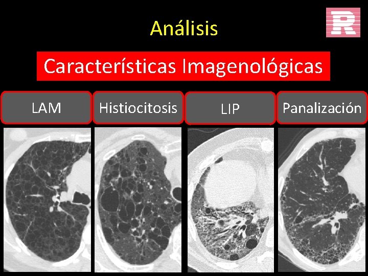 Análisis Características Imagenológicas LAM Histiocitosis LIP Panalización 