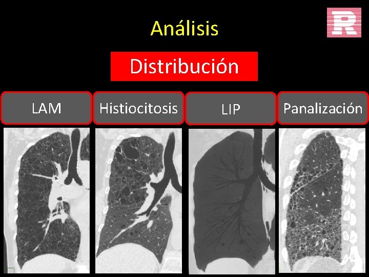 Análisis Distribución LAM Histiocitosis LIP Panalización 