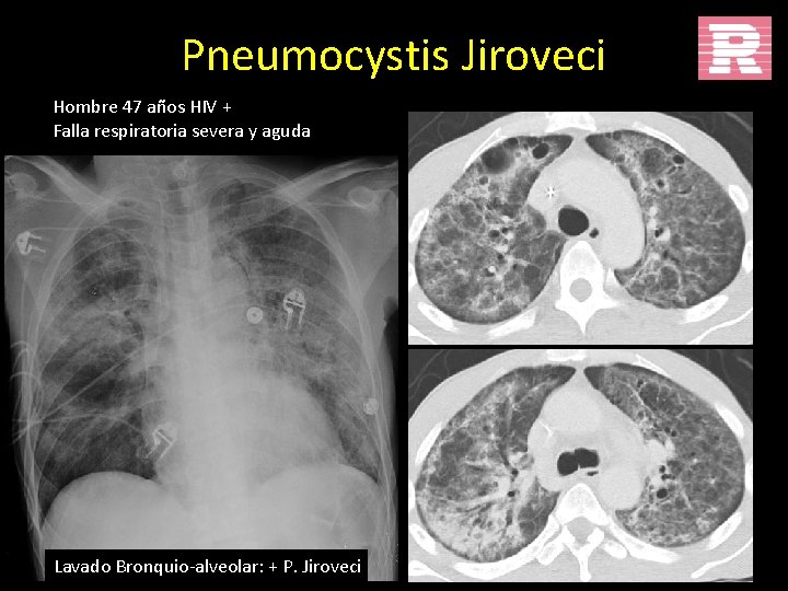 Pneumocystis Jiroveci Hombre 47 años HIV + Falla respiratoria severa y aguda Lavado Bronquio-alveolar: