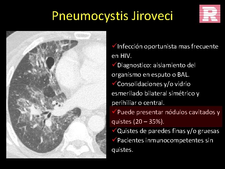 Pneumocystis Jiroveci üInfección oportunista mas frecuente en HIV. üDiagnostico: aislamiento del organismo en esputo