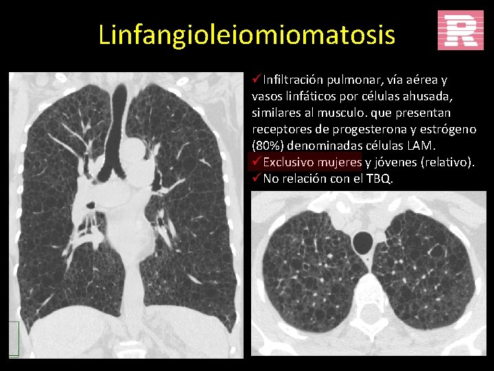 Linfangioleiomiomatosis üInfiltración pulmonar, vía aérea y vasos linfáticos por células ahusada, similares al musculo.