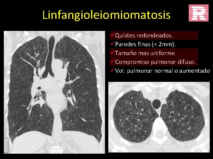 Linfangioleiomiomatosis üQuistes redondeados. üParedes finas (< 2 mm). üTamaño mas uniforme. üCompromiso pulmonar difuso.