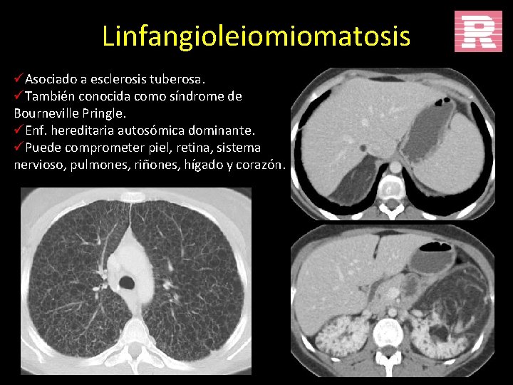 Linfangioleiomiomatosis üAsociado a esclerosis tuberosa. üTambién conocida como síndrome de Bourneville Pringle. üEnf. hereditaria