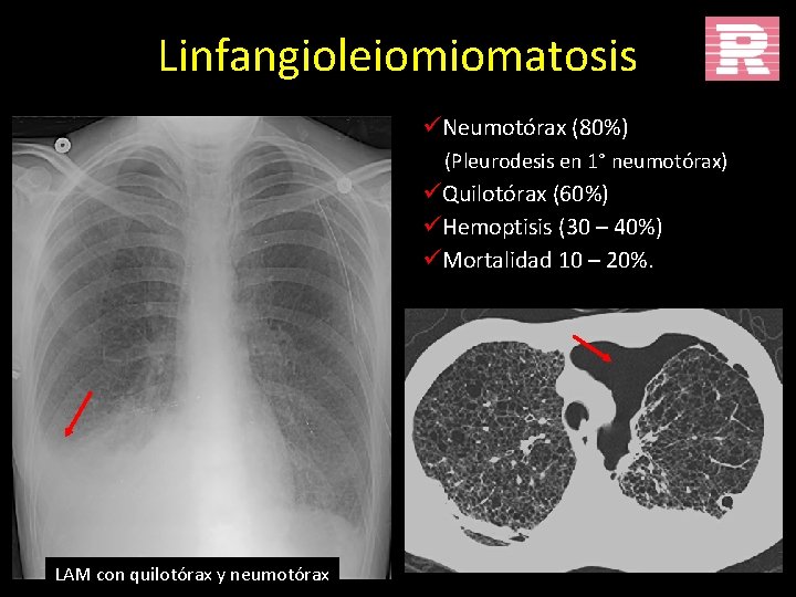 Linfangioleiomiomatosis üNeumotórax (80%) (Pleurodesis en 1° neumotórax) üQuilotórax (60%) üHemoptisis (30 – 40%) üMortalidad