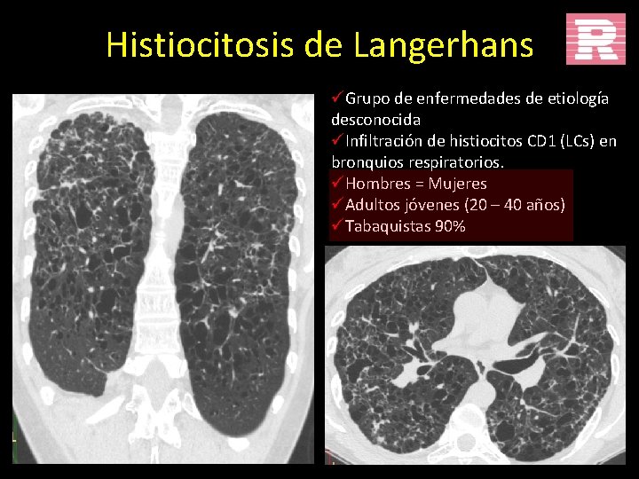 Histiocitosis de Langerhans üGrupo de enfermedades de etiología desconocida üInfiltración de histiocitos CD 1