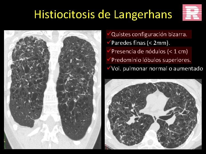 Histiocitosis de Langerhans üQuistes configuración bizarra. üParedes finas (< 2 mm). üPresencia de nódulos