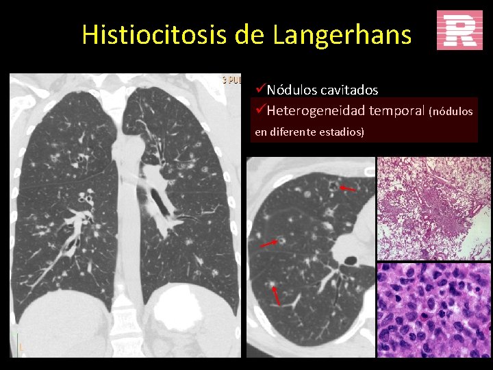 Histiocitosis de Langerhans üNódulos cavitados üHeterogeneidad temporal (nódulos en diferente estadios) 