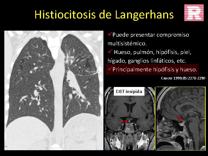 Histiocitosis de Langerhans üPuede presentar compromiso multisistémico. ü Hueso, pulmón, hipófisis, piel, hígado, ganglios