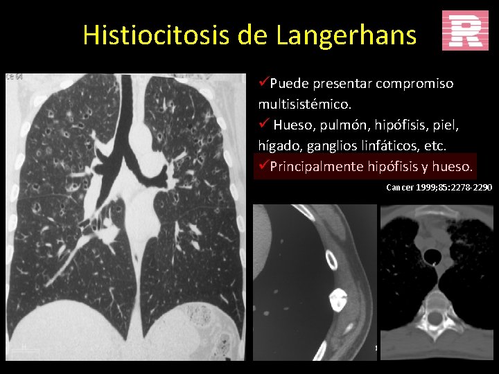 Histiocitosis de Langerhans üPuede presentar compromiso multisistémico. ü Hueso, pulmón, hipófisis, piel, hígado, ganglios