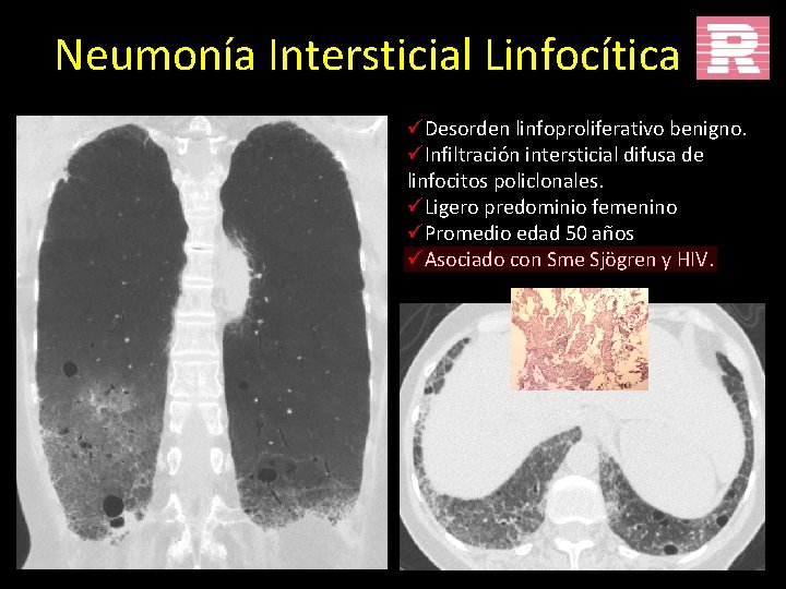 Neumonía Intersticial Linfocítica üDesorden linfoproliferativo benigno. üInfiltración intersticial difusa de linfocitos policlonales. üLigero predominio