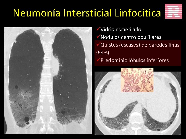 Neumonía Intersticial Linfocítica üVidrio esmerilado. üNódulos centrolobulillares. üQuistes (escasos) de paredes finas (68%) üPredominio