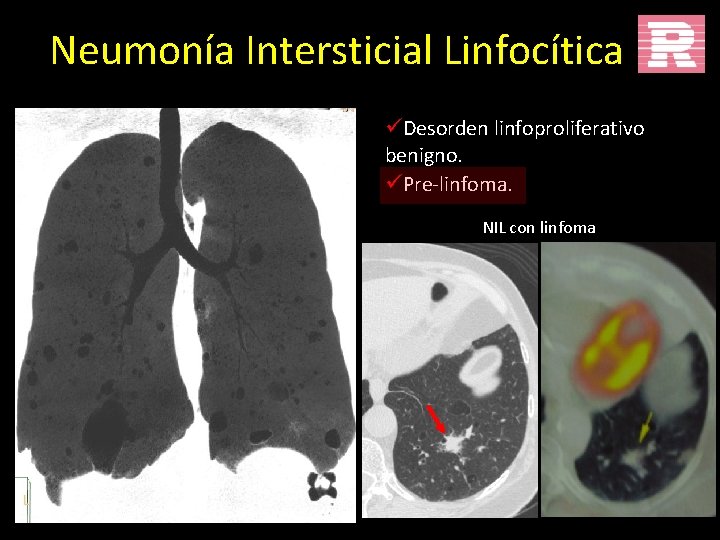 Neumonía Intersticial Linfocítica üDesorden linfoproliferativo benigno. üPre-linfoma. NIL con linfoma 