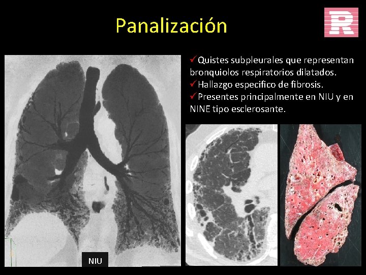 Panalización üQuistes subpleurales que representan bronquiolos respiratorios dilatados. üHallazgo especifico de fibrosis. üPresentes principalmente