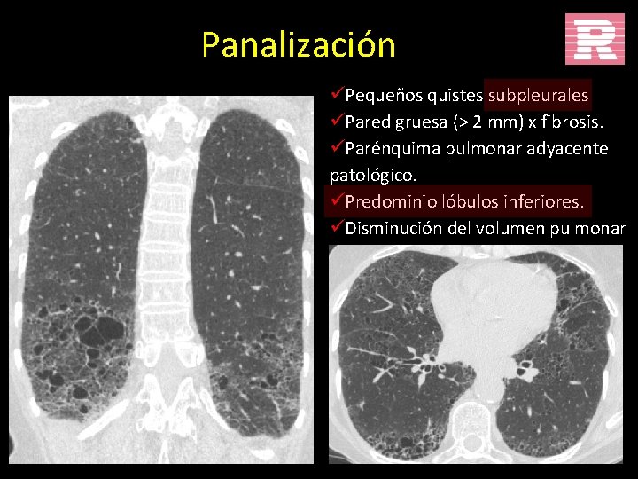 Panalización üPequeños quistes subpleurales üPared gruesa (> 2 mm) x fibrosis. üParénquima pulmonar adyacente