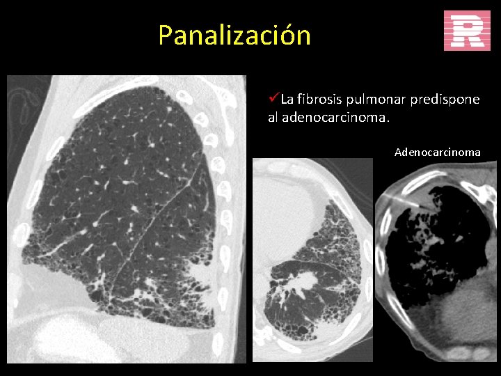 Panalización üLa fibrosis pulmonar predispone al adenocarcinoma. Adenocarcinoma 