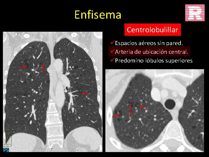 Enfisema Centrolobulillar üEspacios aéreos sin pared. üArteria de ubicación central. üPredomino lóbulos superiores 