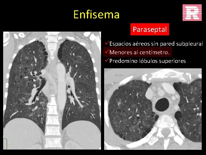 Enfisema Paraseptal üEspacios aéreos sin pared subpleural üMenores al centímetro. üPredomino lóbulos superiores 