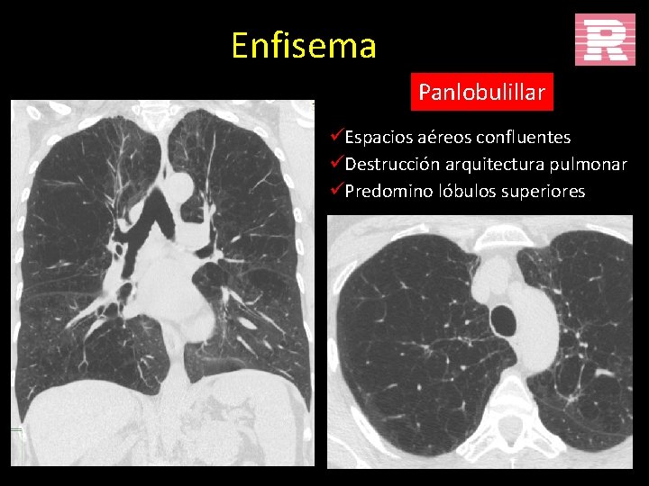 Enfisema Panlobulillar üEspacios aéreos confluentes üDestrucción arquitectura pulmonar üPredomino lóbulos superiores 