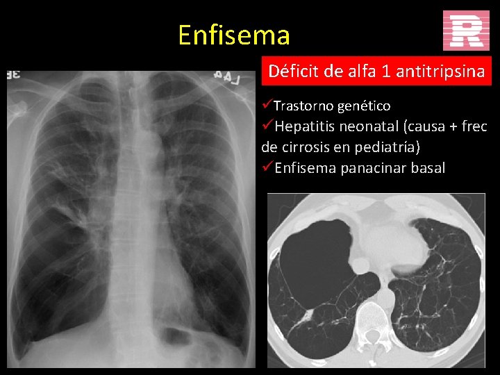 Enfisema Déficit de alfa 1 antitripsina üTrastorno genético üHepatitis neonatal (causa + frec de