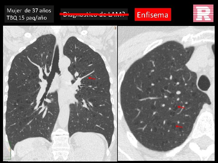 Mujer de 37 años TBQ 15 paq/año Diagnostico de LAM? Enfisema 