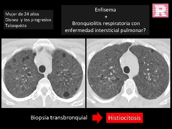 Mujer de 24 años Disnea y tos progresiva Tabaquista Enfisema + Bronquiolitis respiratoria con