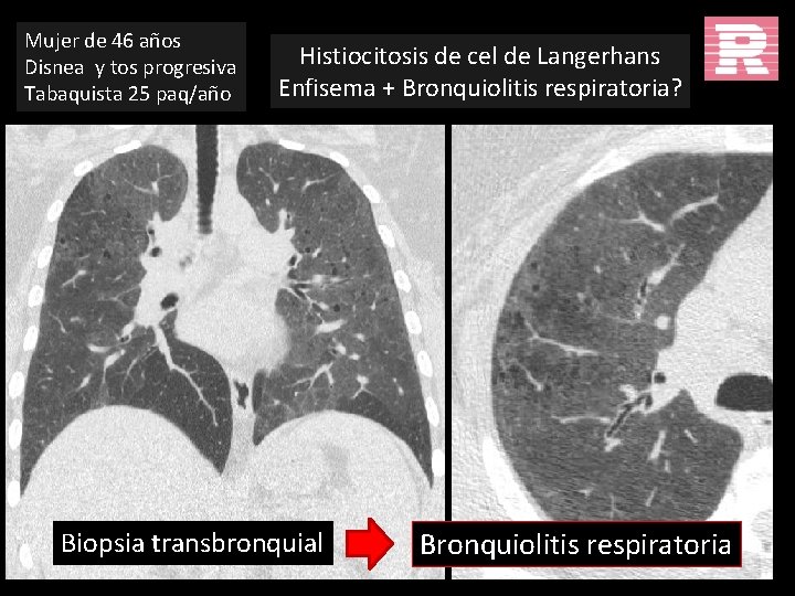 Mujer de 46 años Disnea y tos progresiva Tabaquista 25 paq/año Histiocitosis de cel