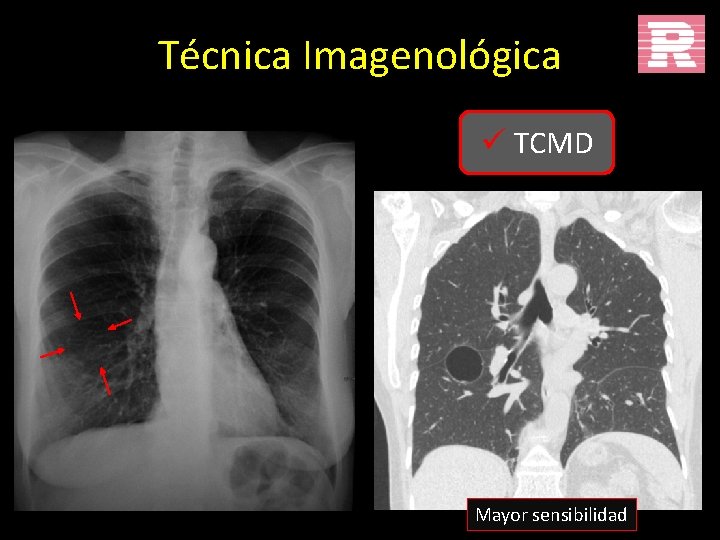 Técnica Imagenológica ü TCMD Mayor sensibilidad 