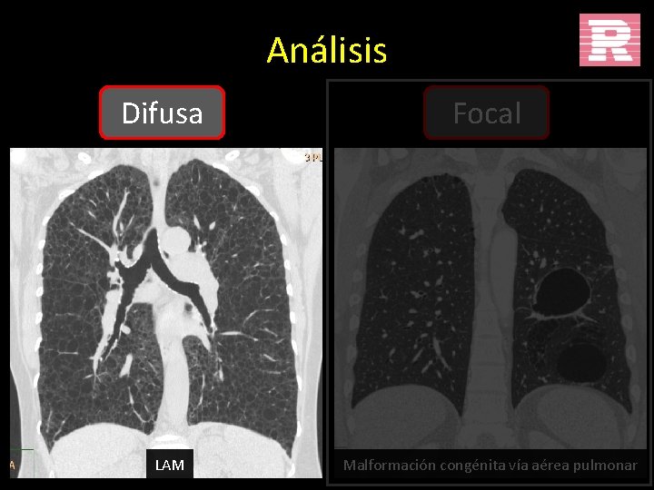 Análisis Difusa LAM Focal Malformación congénita vía aérea pulmonar 