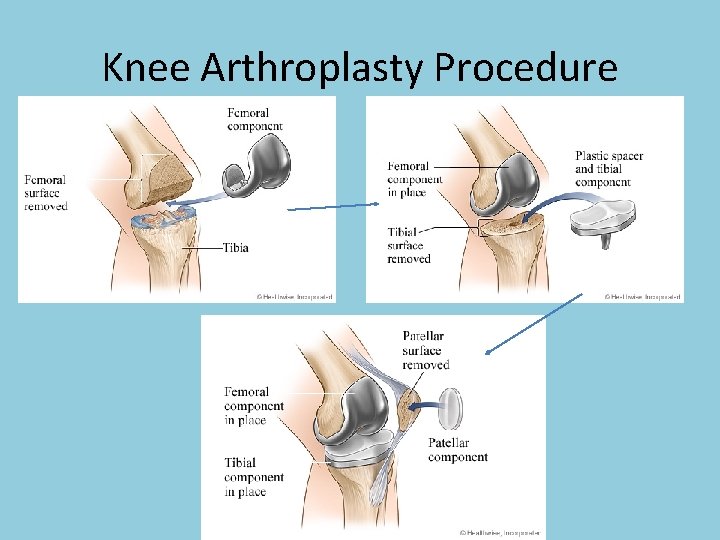 Knee Arthroplasty Procedure 