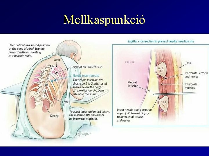 Mellkaspunkció 