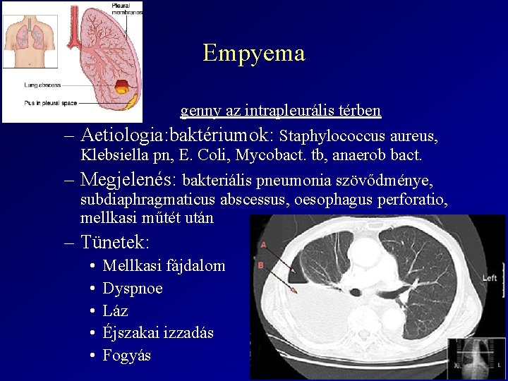 Empyema genny az intrapleurális térben – Aetiologia: baktériumok: Staphylococcus aureus, Klebsiella pn, E. Coli,