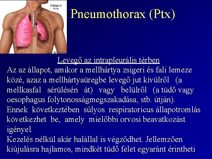 II. Pneumothorax (Ptx) Levegő az intrapleurális térben Az az állapot, amikor a mellhártya zsigeri