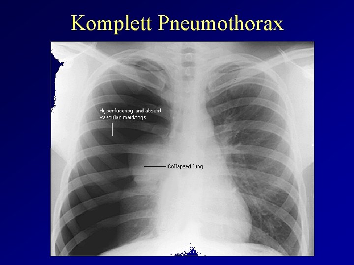 Komplett Pneumothorax 