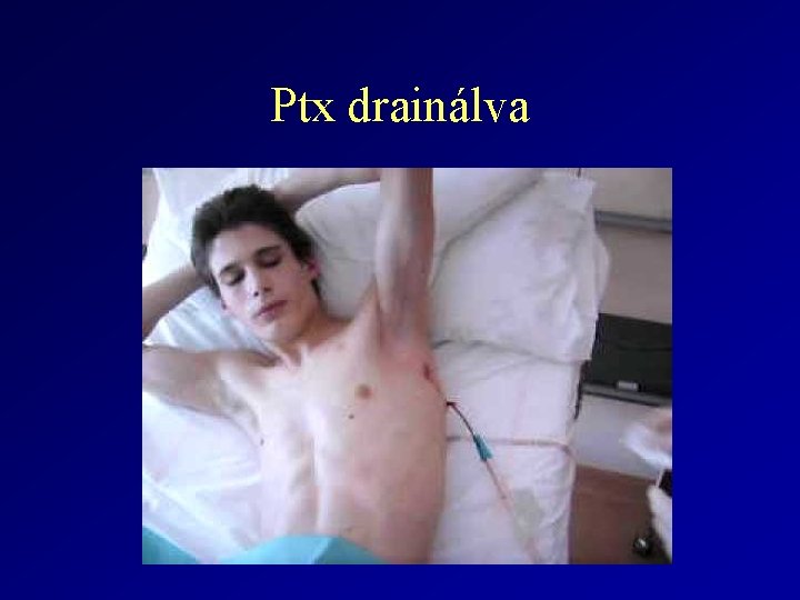 Ptx drainálva 