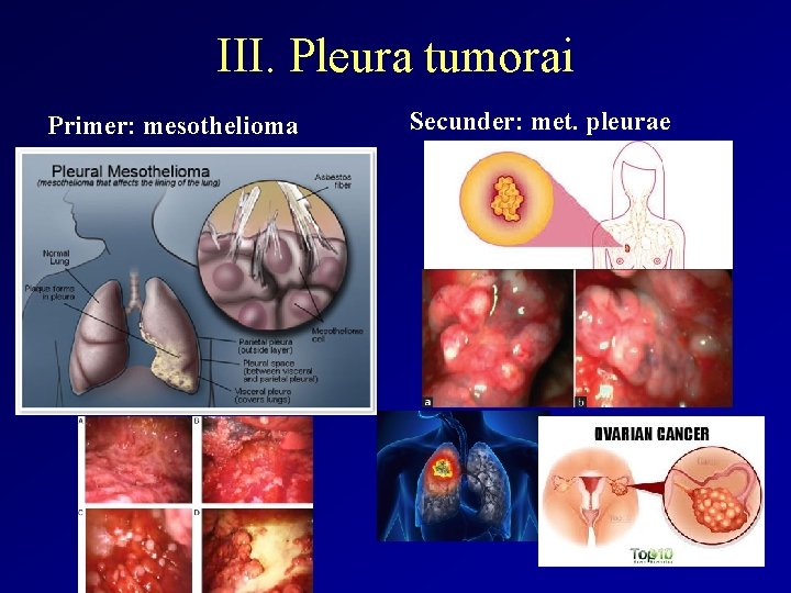 III. Pleura tumorai Primer: mesothelioma Secunder: met. pleurae 