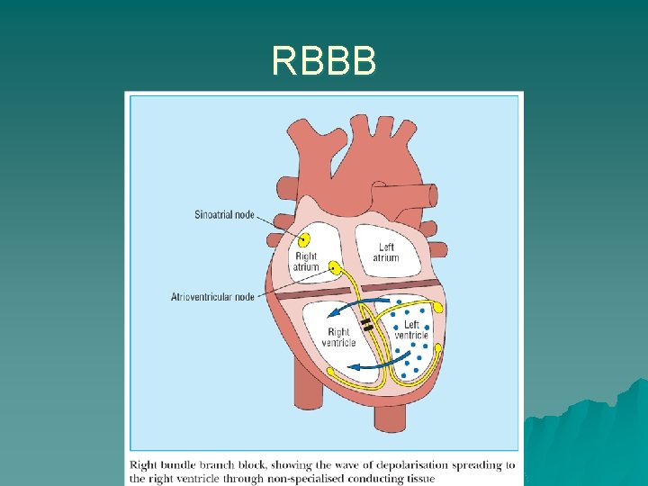 RBBB 