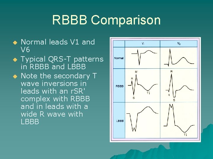 RBBB Comparison u u u Normal leads V 1 and V 6 Typical QRS-T