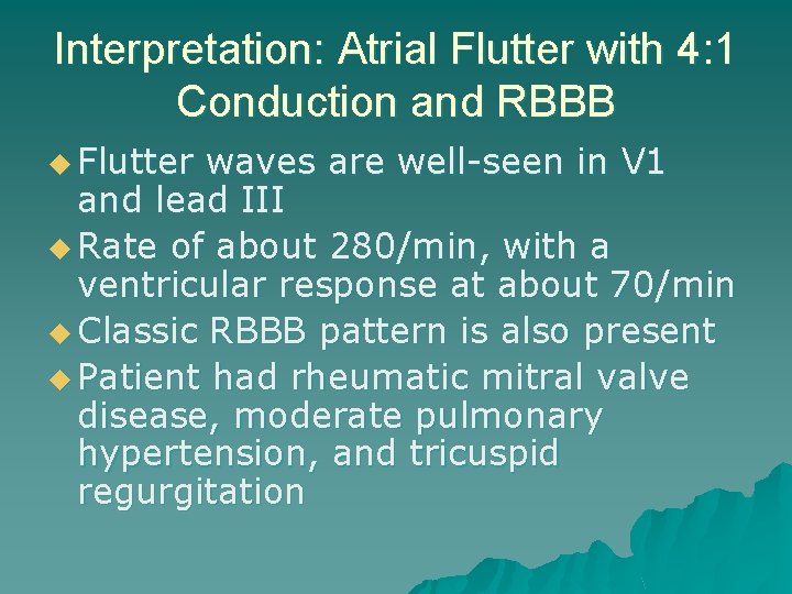 Interpretation: Atrial Flutter with 4: 1 Conduction and RBBB u Flutter waves are well-seen