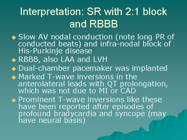 Interpretation: SR with 2: 1 block and RBBB Slow AV nodal conduction (note long