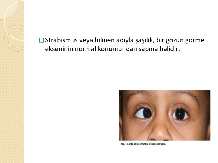 � Strabismus veya bilinen adıyla şaşılık, bir gözün görme ekseninin normal konumundan sapma halidir.