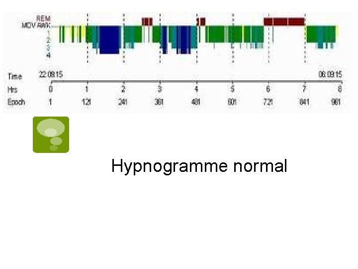 Hypnogramme normal 