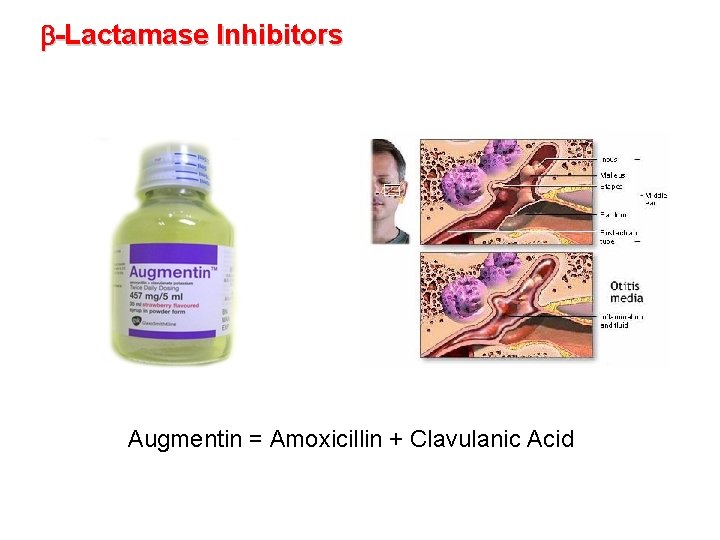 b-Lactamase Inhibitors Augmentin = Amoxicillin + Clavulanic Acid 