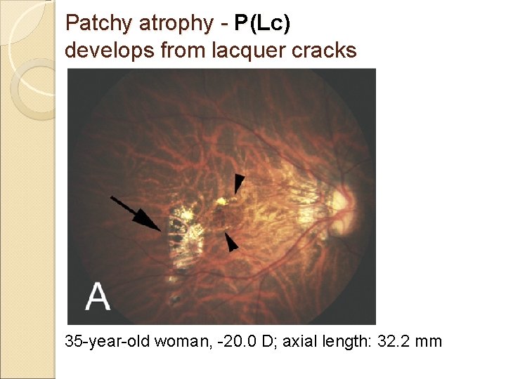 Patchy atrophy - P(Lc) develops from lacquer cracks 35 -year-old woman, -20. 0 D;
