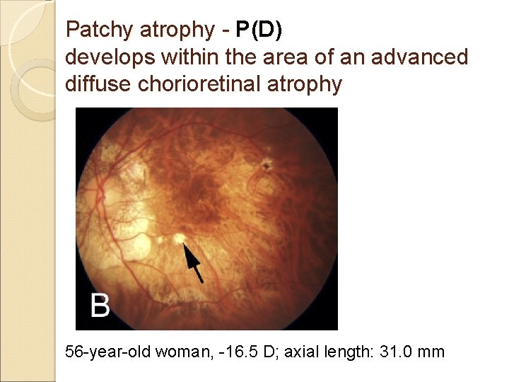 Patchy atrophy - P(D) develops within the area of an advanced diffuse chorioretinal atrophy