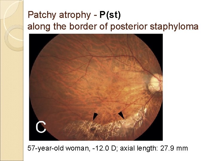 Patchy atrophy - P(st) along the border of posterior staphyloma 57 -year-old woman, -12.
