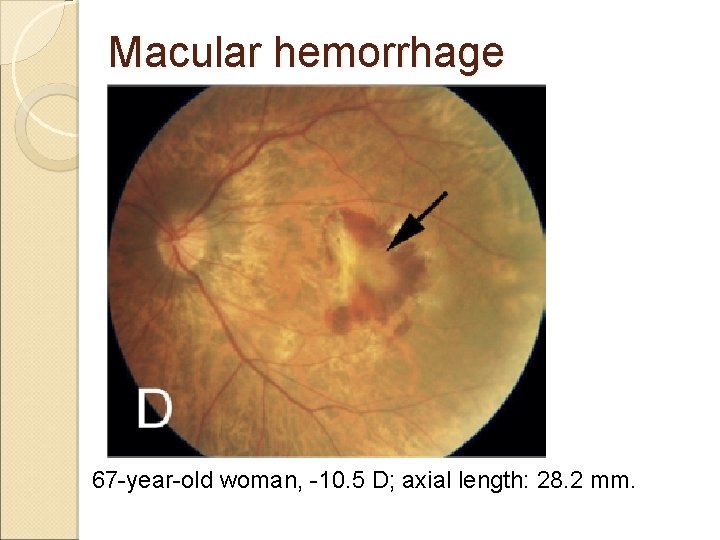 Macular hemorrhage 67 -year-old woman, -10. 5 D; axial length: 28. 2 mm. 