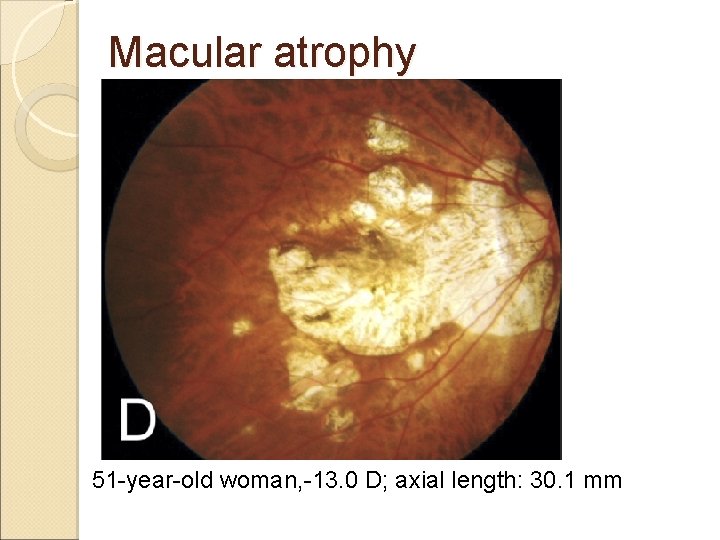 Macular atrophy 51 -year-old woman, -13. 0 D; axial length: 30. 1 mm 