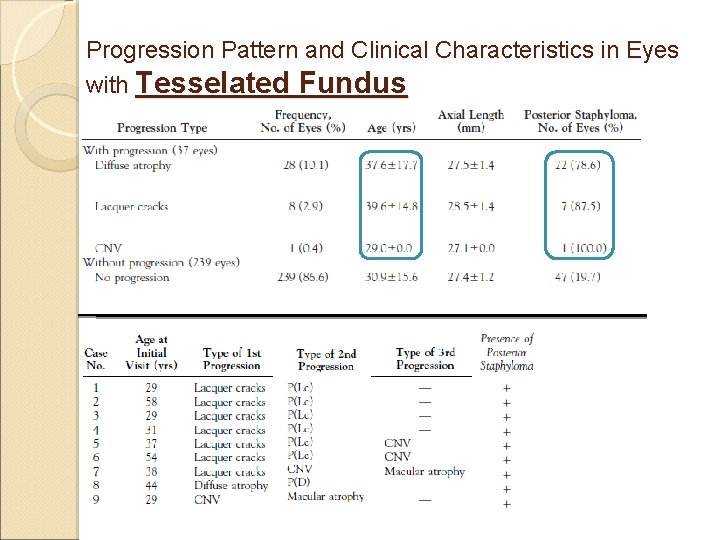 Progression Pattern and Clinical Characteristics in Eyes with Tesselated Fundus 