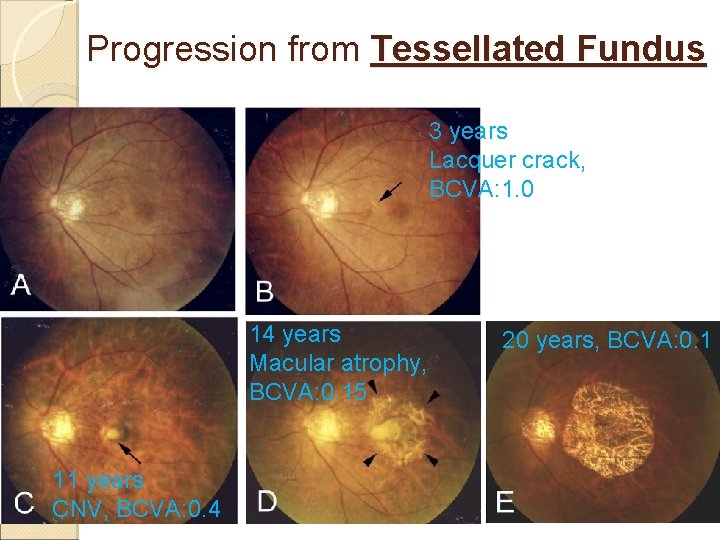 Progression from Tessellated Fundus 3 years Lacquer crack, BCVA: 1. 0 14 years Macular